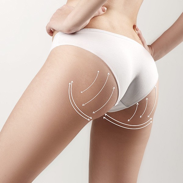 preenchimento_remodelacao-glutea