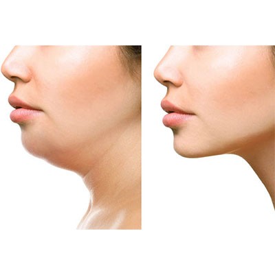 lipopapada_image_2024